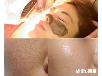 ナチュレアンドメディカ(Nature&Medica)/毛穴専門ケア(IPLカーボン)