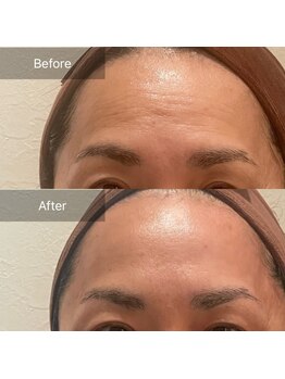 ルナスーリヤ 仙台店/ハーブピーリング