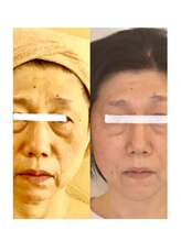 しみ改善サロン リフィーナ/口横のポヨポヨたるみスッキリ！