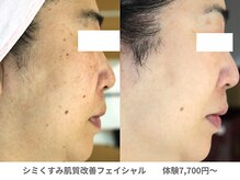 ピュアノア 垂水店/肌質改善フェイシャル　神戸垂水