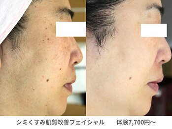 ピュアノア 垂水店/肌質改善フェイシャル　神戸垂水