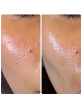 セットアップ鍼灸院(setup鍼灸院)/幹細胞美容鍼