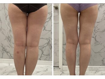 モア 鈴鹿店(more)/施術×痩身クリームでダブル効果