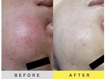 ソアン(Soin)/ダクトピール