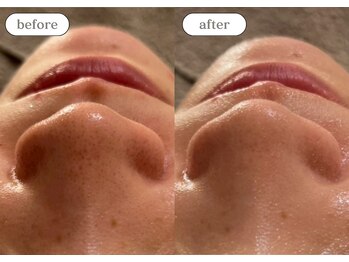 リスタ(RSTA)/【BEFORE/AFTER】