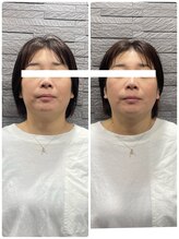 長寿鍼灸院 長寿整骨院/美容鍼50本の効果★小顔効果