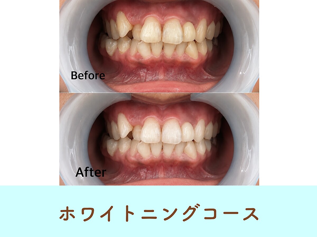<定期メンテナンスに>ホワイトニングコース 通常\14,800→