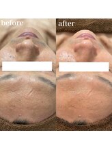 ナチュレ(Nature)/ハーブピーリングbefore→after