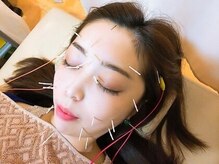 パートナー整体院 高円寺野方院/美容鍼♪