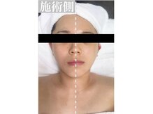 インディバサロン アンド(&.)の雰囲気（リフトアップ・小顔◎術後の腫れ拘縮もお任せください♪）