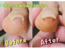 ニコルル 高崎パルクハナミズキ店(Nicolulu)の雰囲気（１回で改善されますが、巻き爪を繰り返さない足を目指します！）