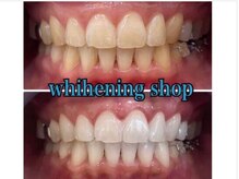 ホワイトニングショップ 京都駅前店/40分×10回Before/Afte