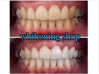 ホワイトニングショップ 京都駅前店/40分×10回Before/Afte