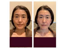 アクア エステティコ 亀有(ACQUA estetico)の雰囲気（シリカピーリング他  ビフォーアフター）