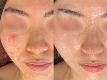 エヌエースキン たまプラーザ店(NAskin)/ハーブピーリング|ニキビケア