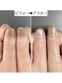 桃の木 吉祥寺店/代謝の悪い爪も改善!2
