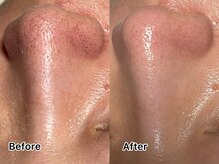 ミルタンドレス(Mille Tendresses)/毛穴洗浄＋部分フェイスワックス