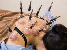 いなほ はりきゅう整骨院 東新宿/鍼灸(吸い玉併用)コース/東新宿