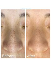 エステ シンセリティー(aesthetic sincerity)/毛穴洗浄9800円→モニター4500円