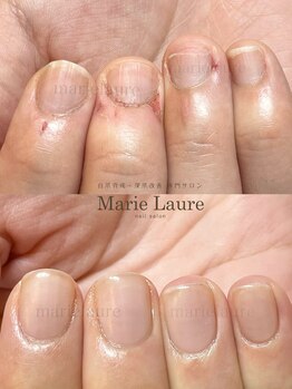 マリーロール 淀屋橋本店(Marie Laure)/自爪育成/深爪矯正/ネイルケア