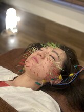 長寿鍼灸院 長寿整骨院/究極のシャワー美容鍼★200本