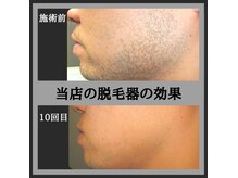 ケイエス(K's)の雰囲気（髭脱毛ビフォーアフター！初回¥1980円♪）