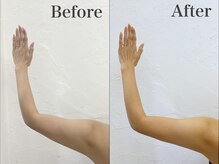 プランドール 京都店(PRENDRE)/二の腕　施術１回目→３回目