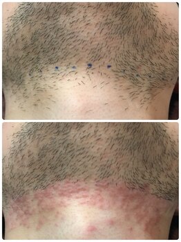 ダブルオー 銀座(00)/美容電気脱毛/髭脱毛/ヒゲ脱毛