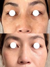 小顔フェイスラボ 鈴鹿店(小顔FaceLabo.)/◆シミ改善◆