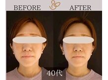 チョコバリ 新宿店(chocobari)/小顔×リフトアップ(美容鍼)40代