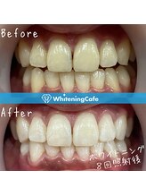 ホワイトニングカフェ 小山店/＊ホワイトニング症例写真＊
