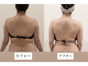 TMサロン 赤坂/背肉、わき肉、お腹同時ケア