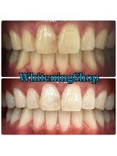 ホワイトニングショップ 吉祥寺店/BEFORE ＆ AFTER