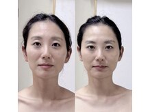 凛&美 銀座/1回施術のビフォーアフター