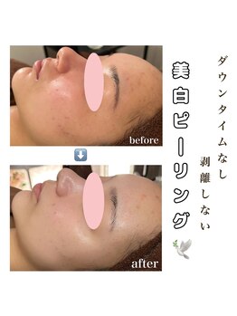 アイリス(AIRIS)/毛穴洗浄/ニキビケア/シミケア