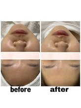 エクスクラメーションマーク(!!!)/はちみつ肌セット