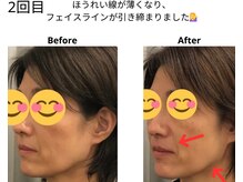 ベル/50代の方の小顔Before After