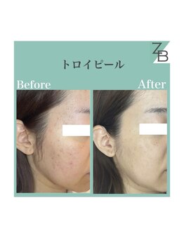 ザラハビューティー(ZARAHA Beauty)/トロイピール