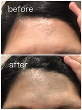 よつ葉/CS60での施術後