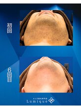 ルミーク(Lumique)/他の追随を許さない圧倒的な効果