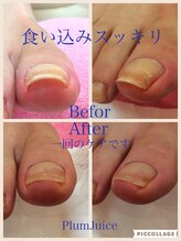 ネイルセラピーサロン プラムジュース(Nail Therapy Salon Plum Juice)/巻爪