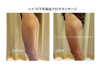 ディアレスト(Dearest)/ハイフ2部位＆アロママッサージ