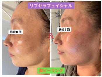 プリュネル(Prunelle)/プラズマシャワー