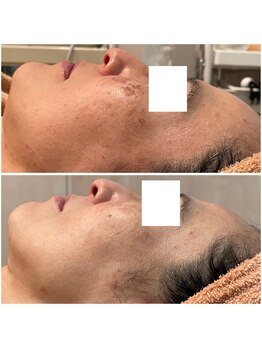 リッツ 所沢店/【Before/After】しみ改善