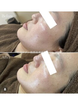 ピエル 北千住店(PIEL)/クリスティーナピーリング