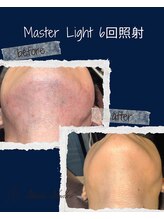 レオナルド(Leonardo)/ヒゲ照射4回