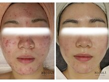 ニコリ(NICOLI)/結果重視/肌管理コース(症例)