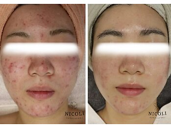 ニコリ(NICOLI)/結果重視/肌管理コース(症例)