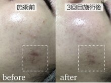 スピカ(Spica)/肌荒れの跡は早めケアが大切！