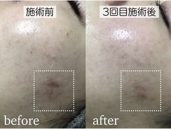 スピカ(Spica)/肌荒れの跡は早めケアが大切!